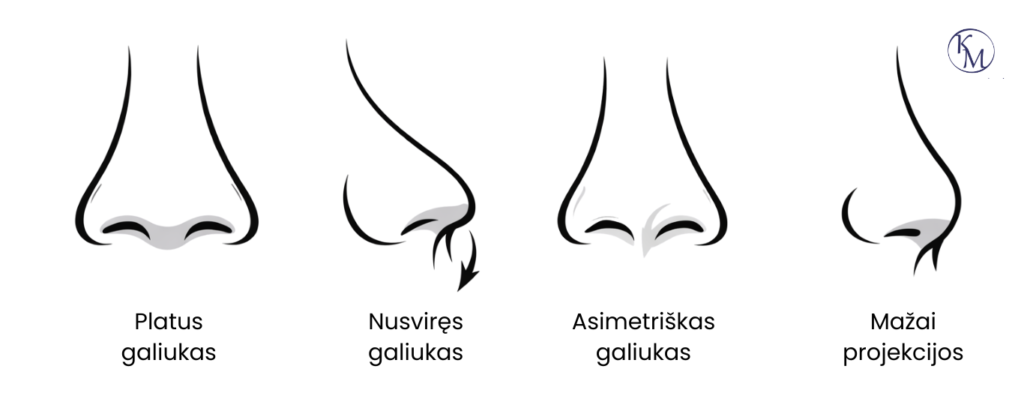 Skirtingos nosies galiuko formos: platus, nusviręs, asimetriškas ir mažai projekcijos.