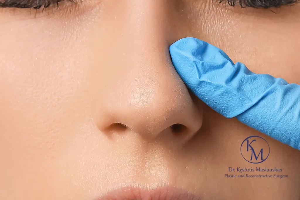 Rinoplastika – mėlyna chirurgine pirštine mūvinti ranka liečia nosies nugarėlę.