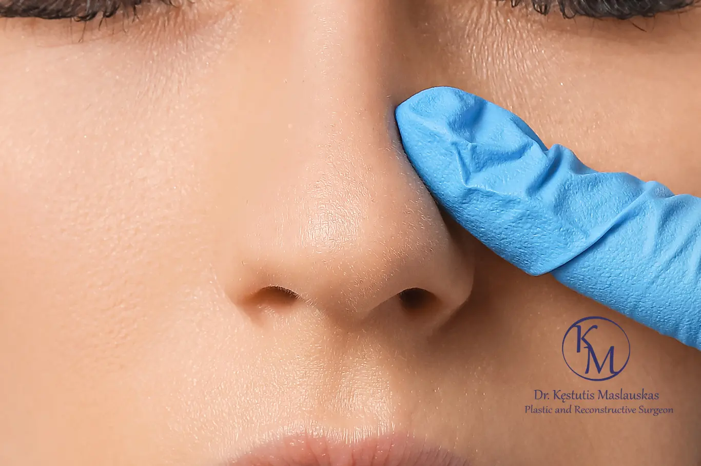 Rinoplastika – mėlyna chirurgine pirštine mūvinti ranka liečia nosies nugarėlę.